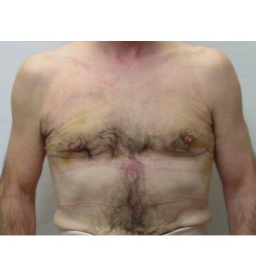 gynecomastio after